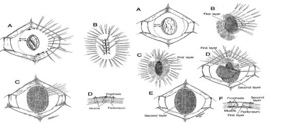 腹部疝气的种类