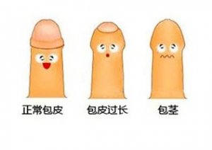 包皮过长图片
